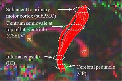 Unbiased MRI Analyses Identify Micropathologic Differences Between Upper Motor Neuron-Predominant ALS Phenotypes